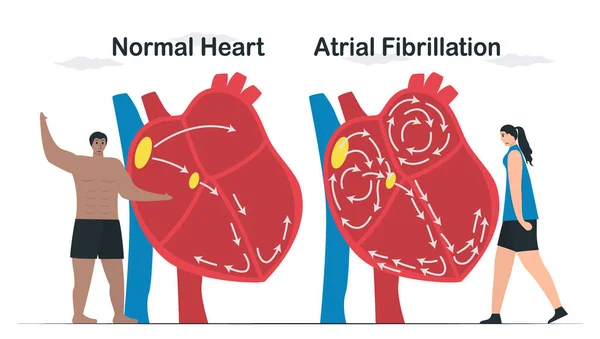 Normal kalp ve Atrial fibrilasyon veri karşılaştırması. AF, düzensiz kalp atışlarının yaygın bir türüdür. Atriyumdaki elektrik sinyalleri atriyumun hızlı ve düzensiz atmasına neden olur. kardiyoloji vektörü.