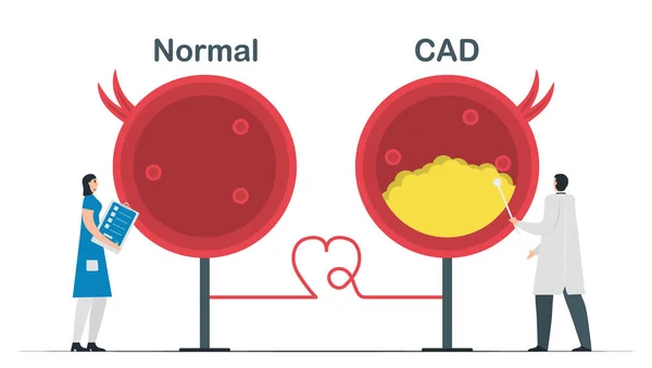 Comparação Cardiopatia Normal Doença Arterial Coronária Ilustração Vetorial Cardiologia Isolada — Vetor de Stock