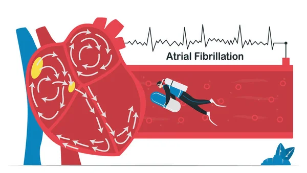 医生治疗一种心房颤动的心脏病 Af是一种常见的不规则心跳类型 心房中的电信号会导致心房快速 不稳定地跳动 心脏科病媒 — 图库矢量图片#