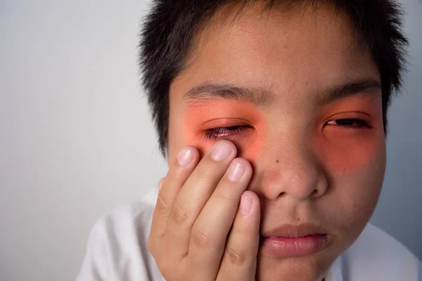 那男孩的眼睛很疼 他用手指按摩眼睛 这张照片是近景 在红色时 它显示症状的位置 — 图库照片#