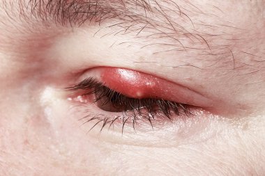 Sore Red Eye. Chalazion and Blepharitis. Inflammation clipart