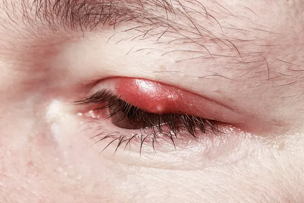 Pijnlijke rode ogen. Chalazion en blefaritis. ontsteking — Stockfoto