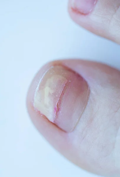 Fracture Détachement Ongle Sur Gros Orteil Maladie Des Ongles Crack Photo De Stock