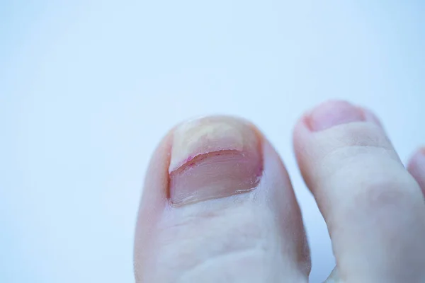 Перелом Отслоение Ногтя Большом Пальце Ноги Заболевание Ногтей Трещина Разрыв Лицензионные Стоковые Изображения