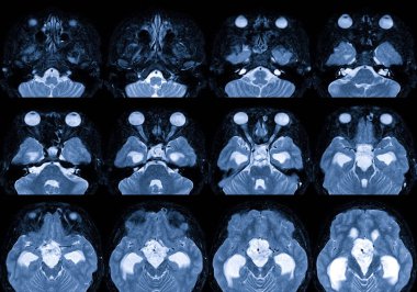 Kontrastlı medya Bulgusu ile MRI Beyni: Suprasellar 'da hipofiz bezi, tıbbi sağlık konsepti sıkıştırmasıyla birlikte 3,5 cm çapında dağınık bir kütle var.