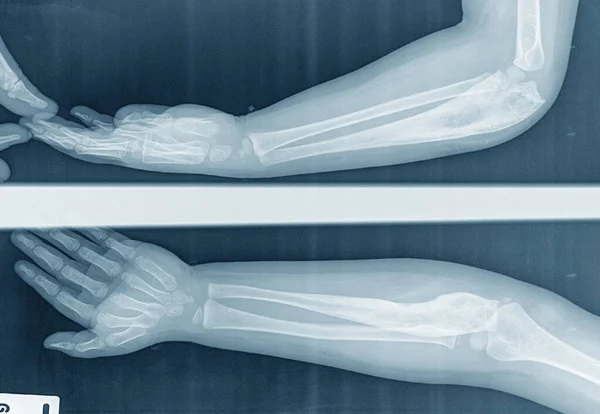 Ein Kind Röntgen Ellbogen Lateral Ansicht Des Unterarms Durch Knochenkrebs — Stockfoto