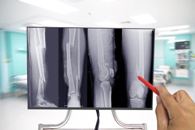 Röntgen cihazını kapat. Tüm bacak kemiğinde kırık, çok sayıda kırık, kırmızı kalem ucu tutan doktor, sağlık sigortası konsepti..
