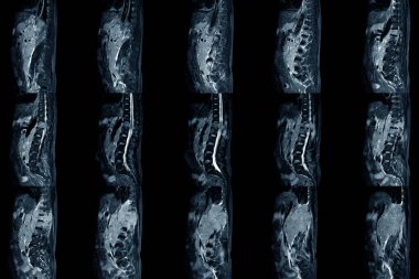 Lumbar spinal stenoz MRI taraması Sagittal görüşü gösteriyor ki orta dereceli alt tümör çıkıntısı çift taraflı kök sıkışmasına neden oluyor. Kronik bel ağrısı hastalığı.