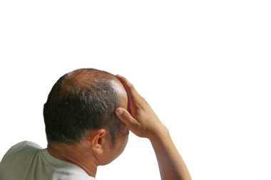 Kel bir adamın oturduğu sahnenin arkasını kapatın. Baş ağrısı ya da sağlığından kaynaklanan stres yüzünden kafasını tutuyor..