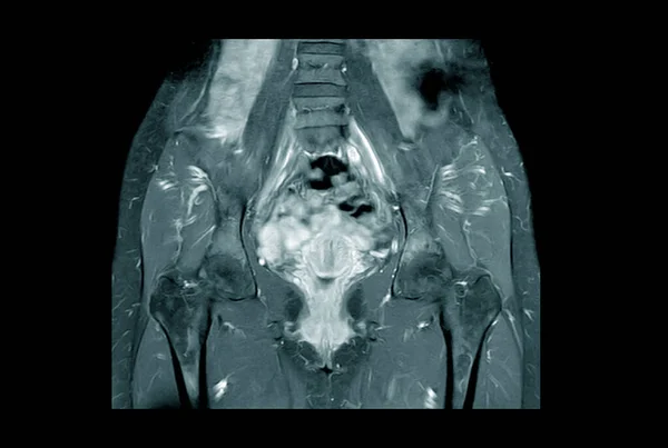 Sağlıklı Bir Kadının Kitle Gibi Anormallikler Bulmasının Manyetik Rezonans Görüntüsü — Stok fotoğraf
