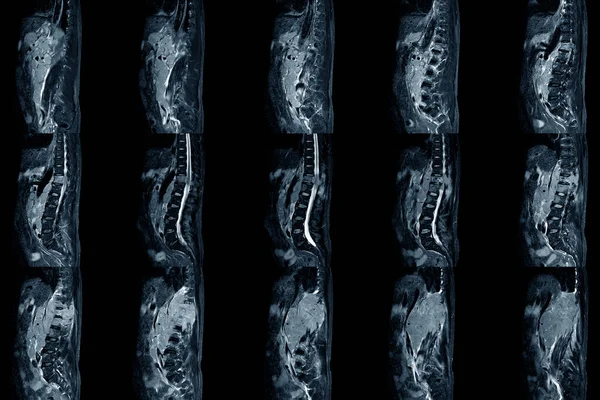 Stenosi Spinale Lombare Scansione Della Risonanza Magnetica Vista Sagittale Protrusione — Foto Stock