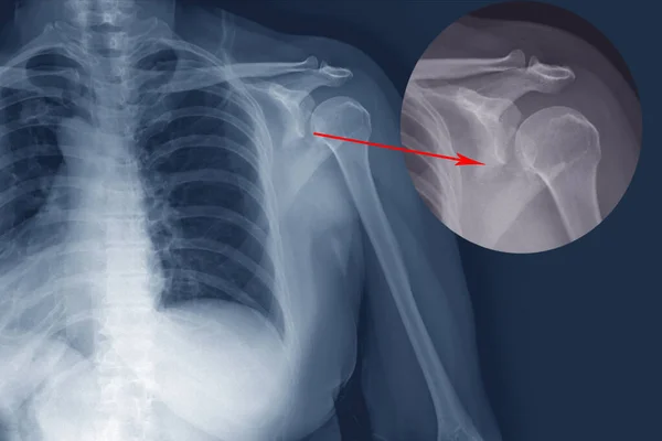 Röntgenschulterfraktur Hintere Hälfte Des Glenoids Mit Posteriorer Dislokation Des Knochenfragments — Stockfoto