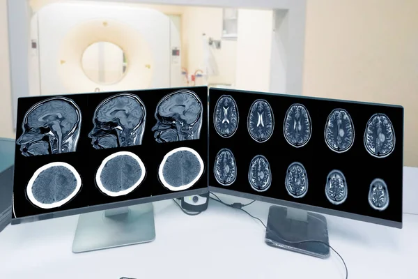 关闭Ct扫描控制室 在脑Ct扫描室背景 医疗保健和技术概念中展示脑图像脑膜瘤 — 图库照片