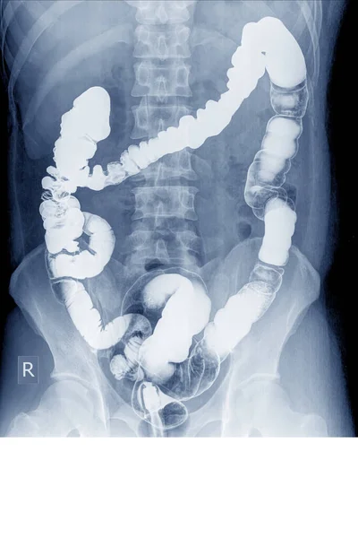 Radiological Examination Look Colon Abnormalities Enema Barium Powder Air Anus — Foto de Stock