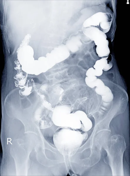 Radiological Examination Look Colon Abnormalities Enema Barium Powder Air Anus — Foto Stock