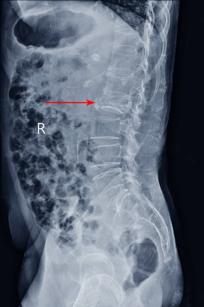 Radiografía Película Espina Dorsal Vista Lateral Mostrando Fractura Por Explosión — Foto de Stock