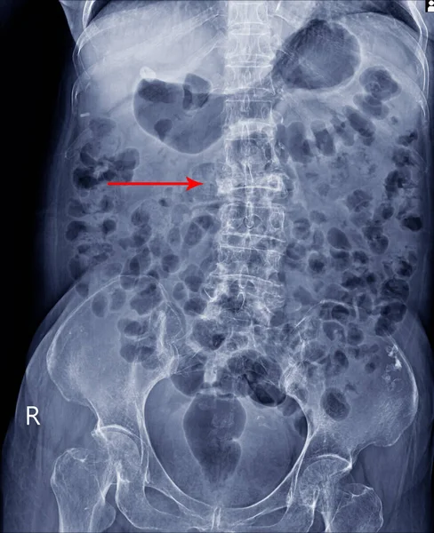 Film Röntgenbild Wirbelsäule Ansicht Zeigt Berstfraktur Des Wirbelkörpers Mit Schwerem — Stockfoto