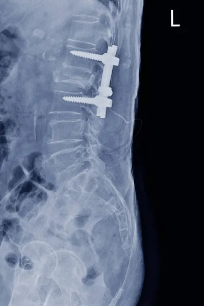 用术后钢板和螺钉显示L2椎体爆裂骨折的X线Ls侧视片 医学图像概念 — 图库照片