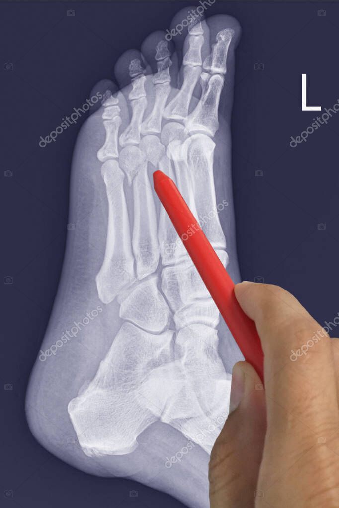 Pie de rayos X de cerca Muestra lateral fractura 3º, 4º hueso