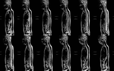 ThORACIC omurgasının MRI 'sı her iki bacağında parezi ve parestezi ile sunuluyor. Akut transvers miyelit, tıbbi sağlık konsepti..