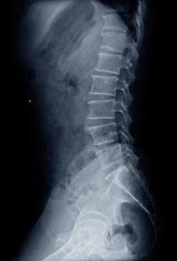X-ray L-S omurgasının yan görüntülerinde L1 omurunda basınç kırığı görülüyor. Tıbbi görüntü kavramı.