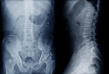 X-ray L-S omurgası AP, Lat görüşü, L1 omurunda kırık olduğunu gösteriyor. Tıbbi görüntü kavramı.