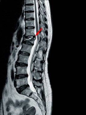 THORACOLUMBAR SPINE MRI L1 omurunda orta ve şiddetli sıkıştırma kırığı.