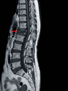 THORACOLUMBAR SPINE MRI L1 omurunda orta ve şiddetli sıkıştırma kırığı.
