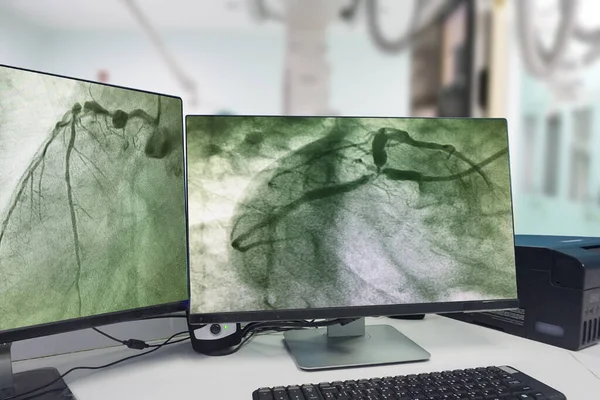 现代Cath实验室液晶显示停机上的冠状动脉造影 Cag 及在医院Cath实验室背景下与医生 病人的模糊 — 图库照片