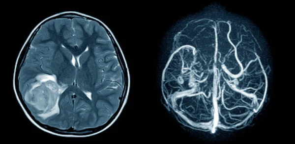 Imagerie Par Résonance Magnétique Cerveau Arm Avec Mrv Cerveau Impression — Photo