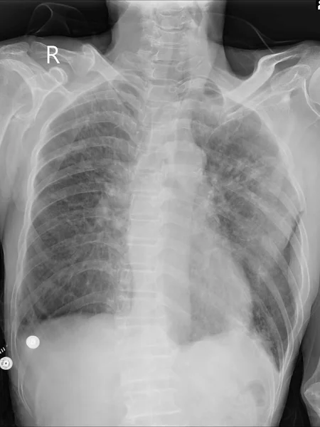 Рентгенівське Дослідження Грудної Клітини Інтерстиціальна Легенева Інфільтрація Легенів Нормального Розміру — стокове фото