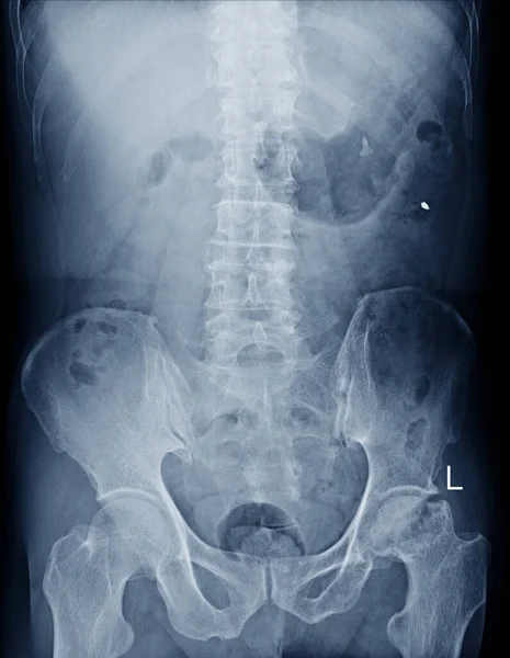Radiografía Película Espina Dorsal Vistas Que Muestran Fractura Por Compresión — Foto de Stock