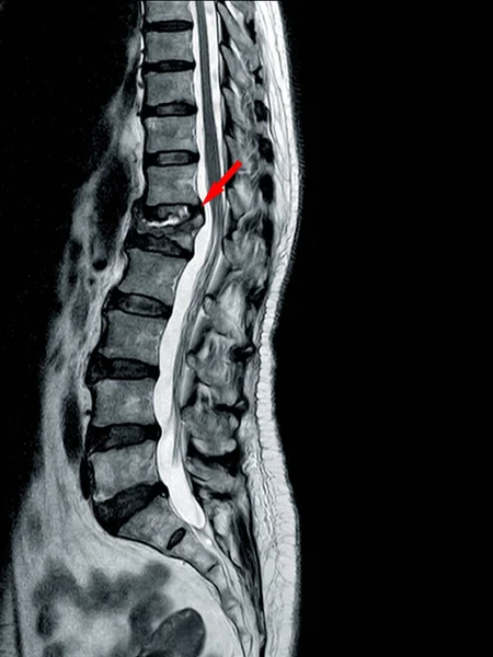 Mri Thoracolumbar Spine Μέτριο Έως Σοβαρό Κάταγμα Συμπίεσης Του Σπονδύλου — Φωτογραφία Αρχείου