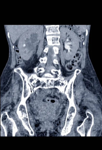 Desfocada Digitalizar Abdômen Inferior Hidronefrose Grave Rim Com Obstrução Ureteral — Fotografia de Stock