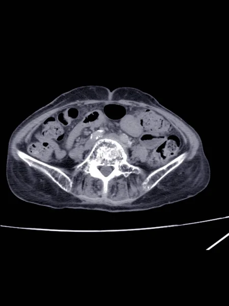 Blurry Scan Lower Abdomen Severe Hydronephrosis Kidney Distal Ureteric Obstruction — Stock Photo, Image