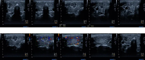 Close Report Ultrasound Neck Thyroid Gland Medical Healthcare Concept — Stock Photo, Image