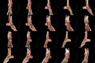 Close up ankle x ray 3d distal tibia anatomy.