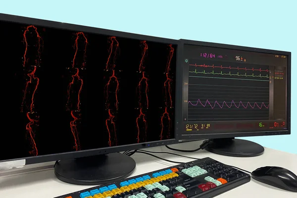 Angiographie Coronaire Membre Inférieur Occlusion Artère Fémorale Superficielle — Photo