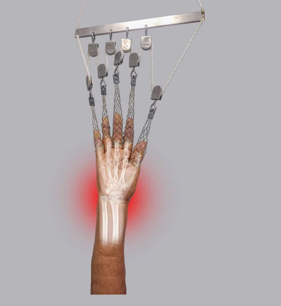 Close Skeleton Traction Frame Patient Fracture Wrist Accident Fracture Hands — Stock fotografie