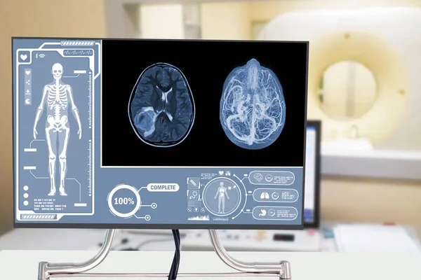 MRI OF THE BRAIN AND MRA & MRV OF THE BRAIN acute parenchymal hemorrhage with small portion of subacute stage centered Medical healthcare and technology concept.