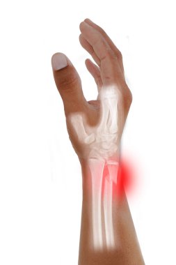 Hand and wrist x-ray Oblique view fracture distal ulna pain and swelling ,Medical image concept on white background.