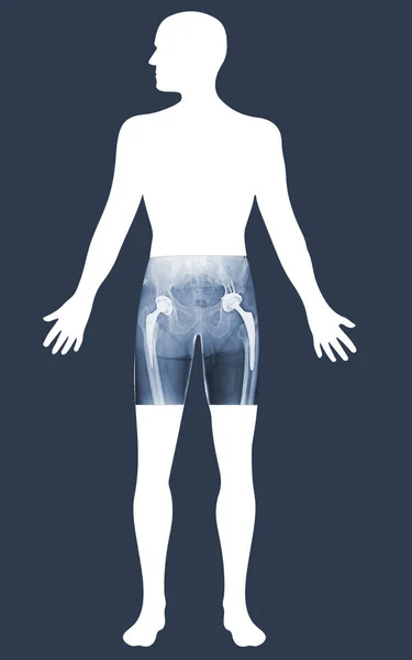 Viewing analytics at Hologram human anatomy and skeleton. X-ray both hip Total Hip Replacement.Medical image concept.