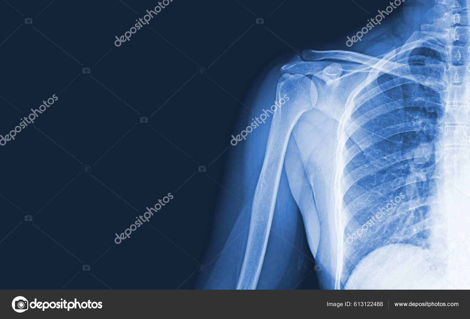 Röntgenbilder Des Schultergelenks Verletzungen Knochen Und Sehnen Für Eine  Medizinische - Stockfotografie: lizenzfreie Fotos © Richmanphoto 613122488