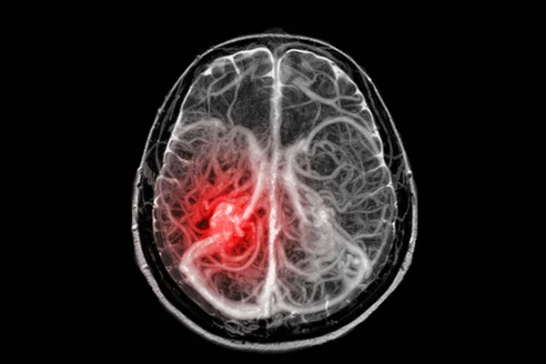 Fúzní Snímky Mri Mra Mozková Nebo Magnetická Rezonanční Angiografie Mra — Stock fotografie