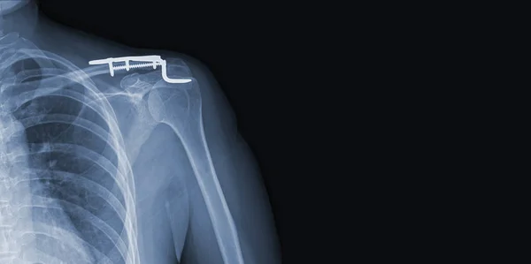 x-ray images of the shoulder joint modified coracoclavicular stabilizer to see injuries bones and tendons for a medical diagnosis.Medical image concept and copy space.