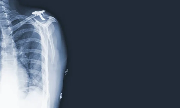 x-ray images of the shoulder joint modified coracoclavicular stabilizer to see injuries bones and tendons for a medical diagnosis.Medical image concept and copy space.