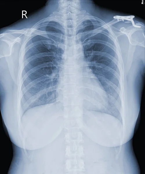 X光影像胸肩关节改良冠状锁骨稳定器 以观察受伤骨骼及肌腱 供医疗诊断之用 医疗影像概念 — 图库照片