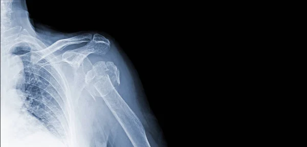 Omuz Eklemlerinin Röntgen Görüntüleri Daha Büyük Tüberküloz Kırıkları Tendonlar Tıbbi — Stok fotoğraf