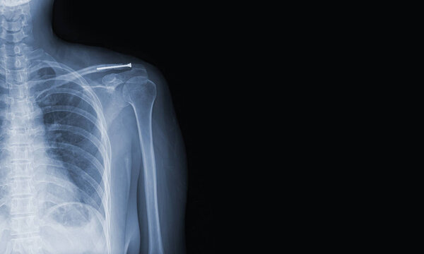 x-ray images of the shoulder joint modified coracoclavicular stabilizer to see injuries bones and tendons for a medical diagnosis.Medical image concept and copy space.