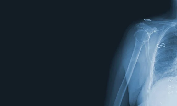 Imagens Raios Articulação Ombro Para Ver Lesões Ossos Tendões Para — Fotografia de Stock